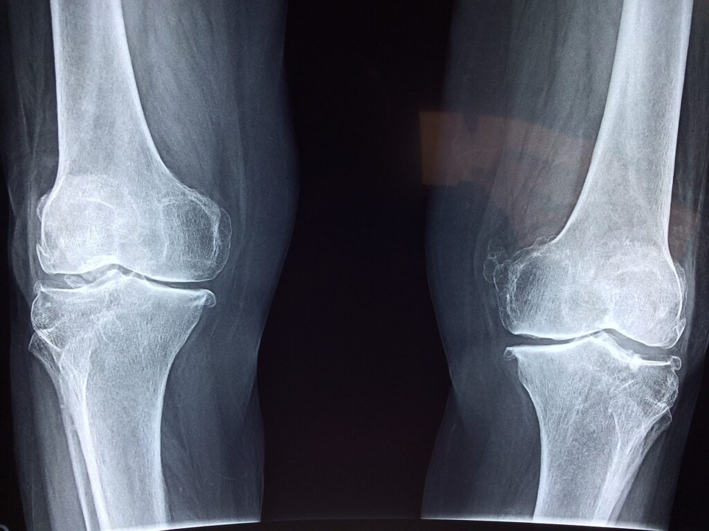 knee, x-ray, medical